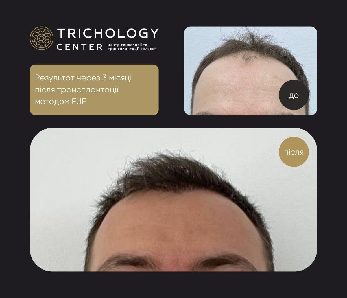 Пересадка волосся фото до і після Trichology Center 4